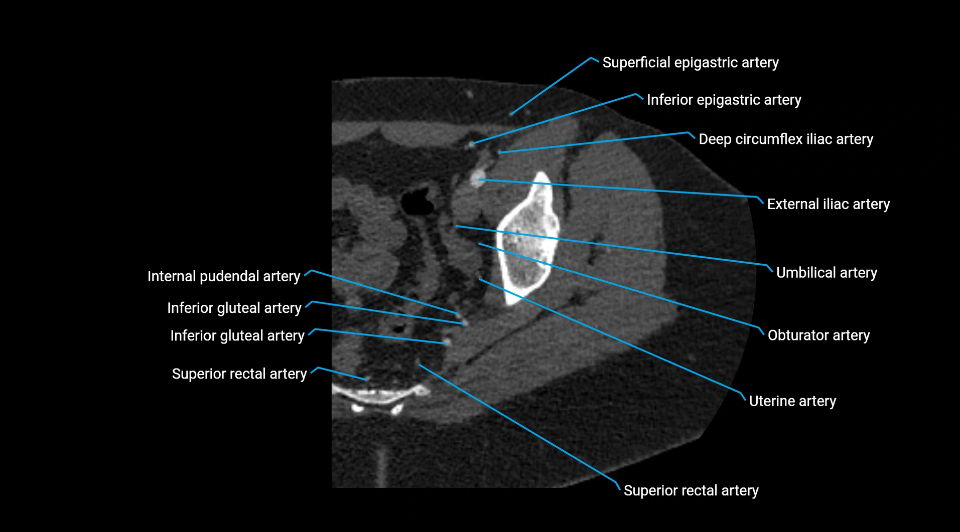 CTA lower limb cross sectional anatomy labelled image _45.webp